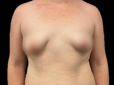 Before — Breast Augmentation, Patient #58209