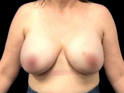 After — Breast Implant Revision, Patient #91081