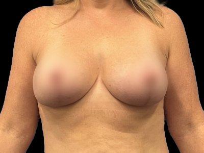 After — Breast Implant Revision, Patient #10515
