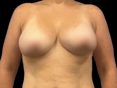 Before — Breast Implant Revision, Patient #10515