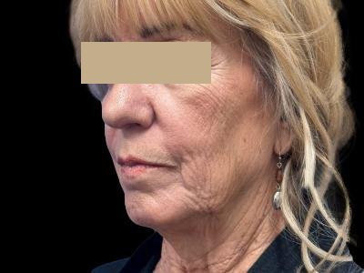 Before — Facelift, Patient #99649