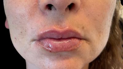 After — Fillers, Patient #39271