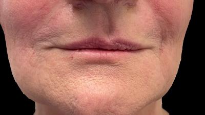 Before — Fillers, Patient #22841