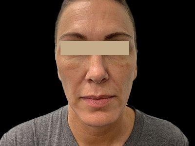 After — P.R.O. Facial Rejuvenation, Patient #33473