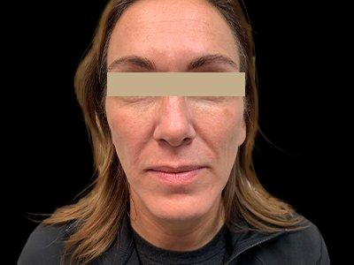 Before — P.R.O. Facial Rejuvenation, Patient #33473