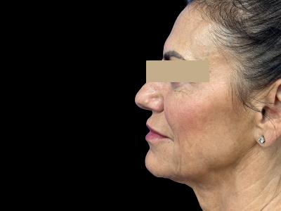 Before — P.R.O. Facial Rejuvenation, Patient #33471