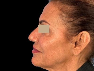 After — ReGen Dermacore, Patient #41690