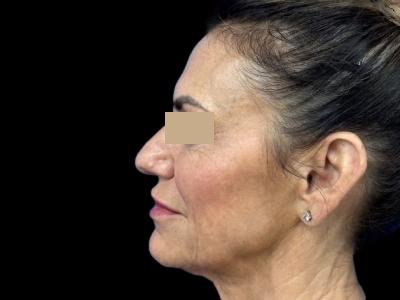 Before — ReGen Dermacore, Patient #41690