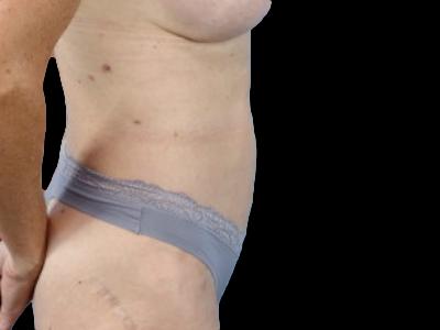After — S.M.A.R.T. Tummy Tuck, Patient #90729, view 3