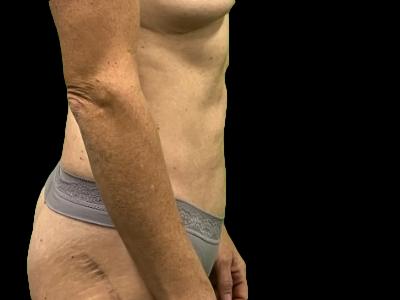 Before — S.M.A.R.T. Tummy Tuck, Patient #90729, view 3