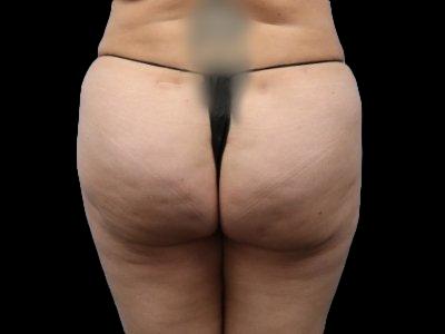 After — True Curve BBL, Patient #46502