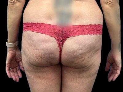 Before — True Curve BBL, Patient #46502
