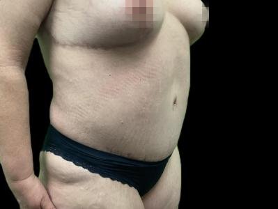 After — Tummy Tuck, Patient #96569