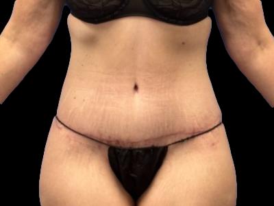 After — Tummy Tuck, Patient #62125