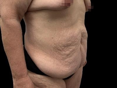Before — Tummy Tuck, Patient #96569