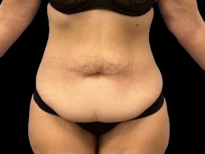 Before — Tummy Tuck, Patient #62125