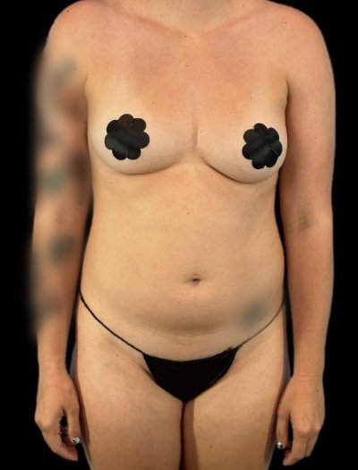 Before — 360° Refyne, Patient #15197