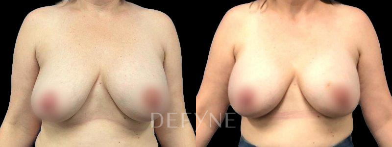 Patient #91081 Combined Image