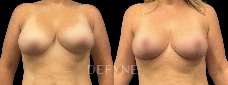 Patient #10515 Combined Image