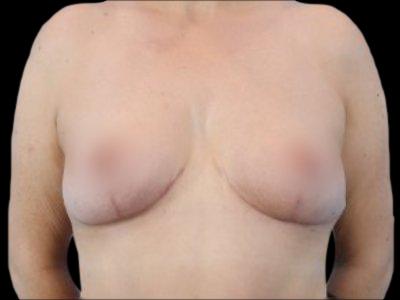 After — Breast Lift, Patient #84642