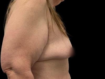 Before — Breast Lift, Patient #56213
