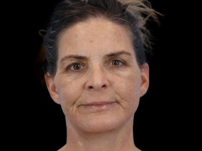 After — Facelift, Patient #20066