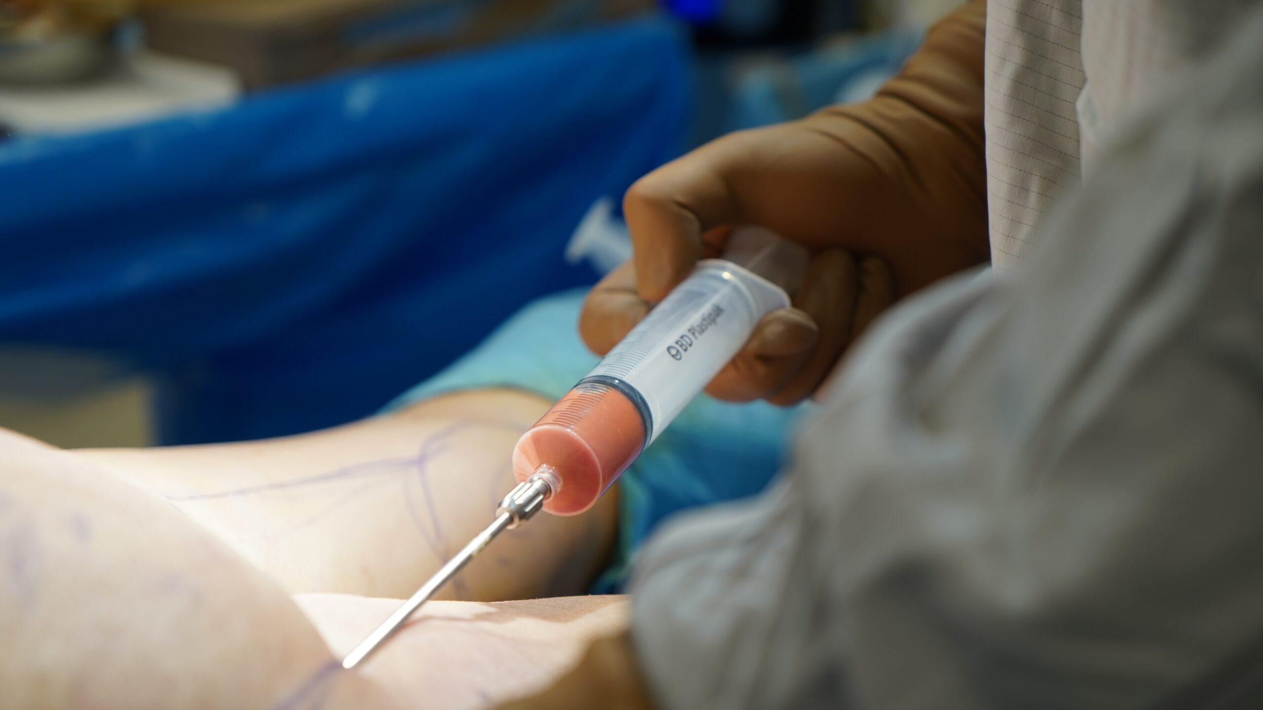 Latest Advancements in Fat Grafting 