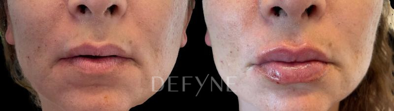 Patient #39271 Combined Image