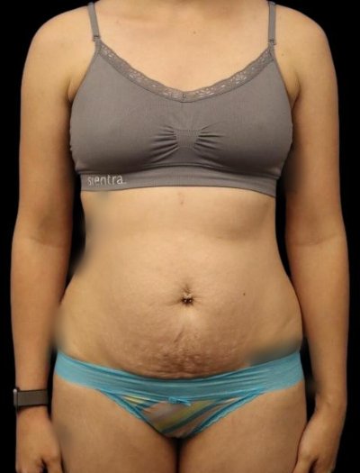 Before — Mommy Makeover, Patient #72280