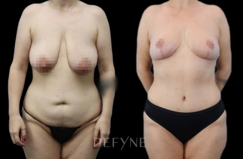 Patient #10987 Combined Image