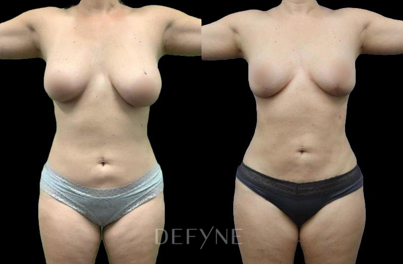 Patient #42693 Combined Image