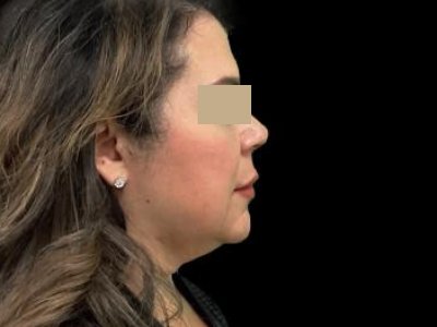 Before — Overnight Lift, Patient #29874