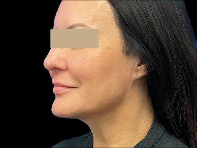 After — P.R.O. Facial Rejuvenation, Patient #33472