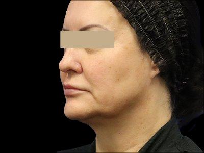 Before — P.R.O. Facial Rejuvenation, Patient #33472