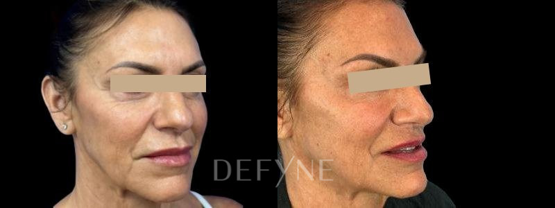 Patient #41690 Combined Image