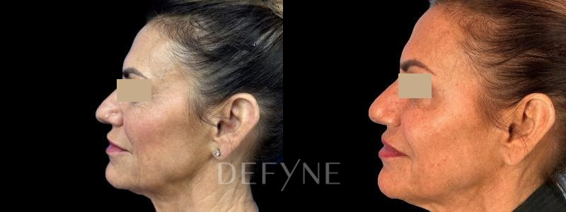 Patient #41690 Combined Image