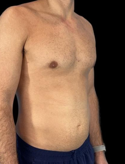 After — S.M.A.R.T. Core Contour, Patient #37185