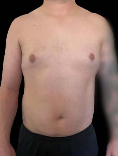 After — S.M.A.R.T. Core Contour, Patient #37184