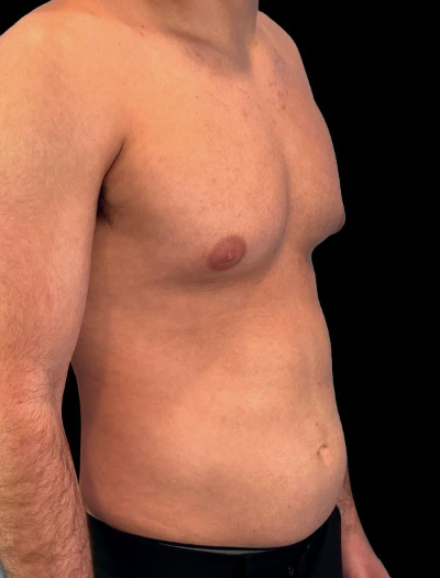 Before — S.M.A.R.T. Core Contour, Patient #37185