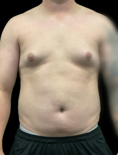 Before — S.M.A.R.T. Core Contour, Patient #37184