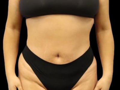 After — S.M.A.R.T. Tummy Tuck, Patient #75695