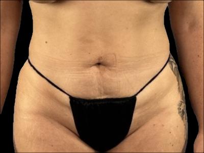 After — S.M.A.R.T. Tummy Tuck, Patient #15520