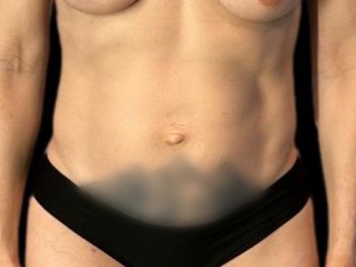 After — S.M.A.R.T. Tummy Tuck, Patient #26904