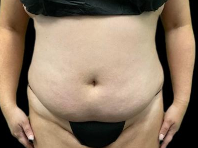 Before — S.M.A.R.T. Tummy Tuck, Patient #75695