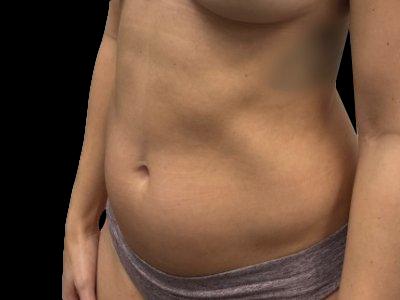 Before — S.M.A.R.T. Tummy Tuck, Patient #72807