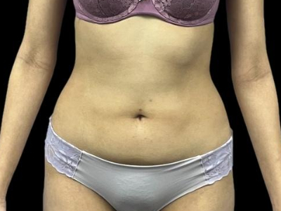Before — S.M.A.R.T. Tummy Tuck, Patient #68062