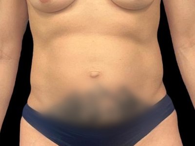 Before — S.M.A.R.T. Tummy Tuck, Patient #26904