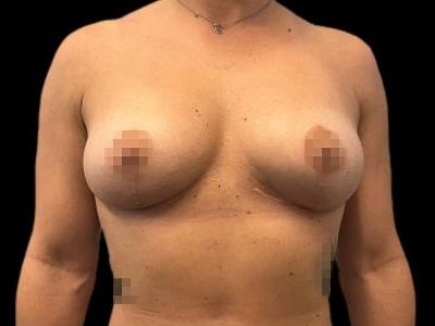 After — The True Shape Breast Augmentation, Patient #75828