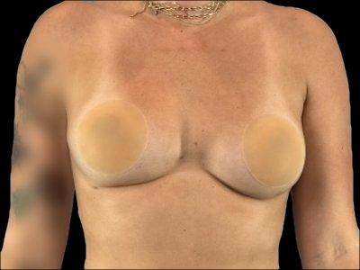 After — The True Shape Breast Augmentation, Patient #71860