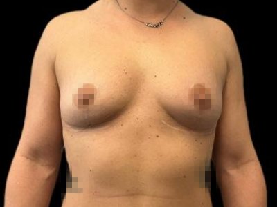 Before — The True Shape Breast Augmentation, Patient #75828